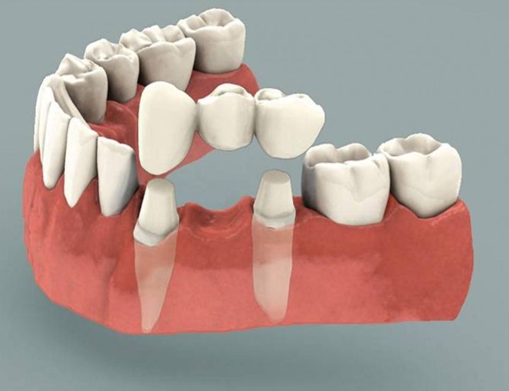 Tooth preparation for crown
